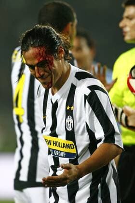 Mauro Camoranesi (Juventus Turin) schwer verletzt  o0 Blut Kopfverletzung o0 Juve