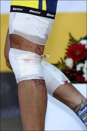 Johnny Hoogerland ( BEL Vacansoleil ) 9. Etappe: Issoire - Saint Flour - 10.07.2011 - xPhotoNewsx  o0 Verletzung bluten Blut blutig Verband Bandage bandagiert Bein Beine Körperteile Siegerehrung