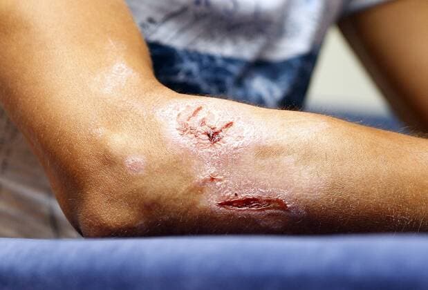 Themen der Woche - Sport Bilder des Tages - SPORT - Alberto Contador. press conference PK Pressekonferenz of Alberto Contador at Cemtro clinic. In this picture, Alberto Contador arm injured. xDAVIDxMOIRONx 
