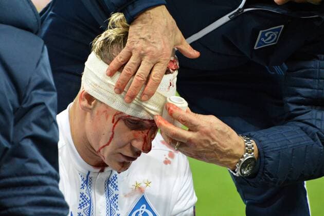 Domagoj Vida breaks his head in the match with BSC Young Boys Kyiv  Copyright: HusevxOleksandr 511092