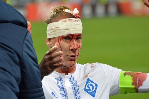 Domagoj Vida breaks his head in the match with BSC Young Boys Kyiv  Copyright: HusevxOleksandr 511093