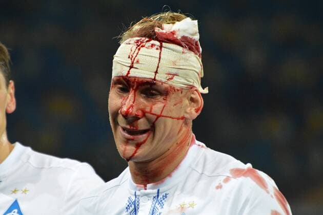 Themen der Woche - SPORT Bilder des Tages - SPORT Domagoj Vida breaks his head in the match with BSC Young Boys Kyiv  Copyright: HusevxOleksandr 511096