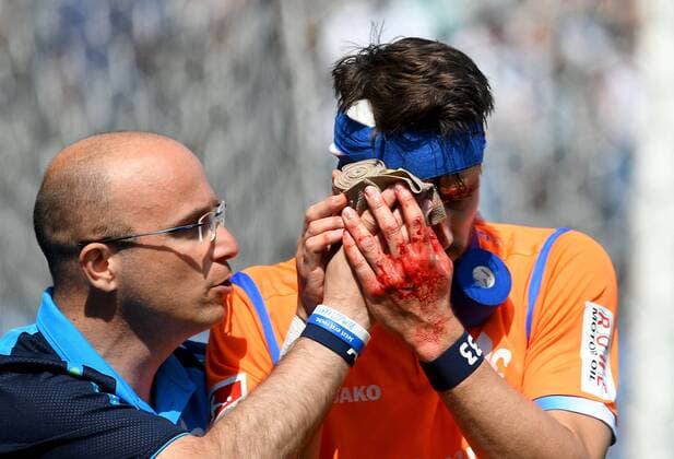 Themen der Woche - SPORT Bilder des Tages - SPORT 21.04.2018, xfux, Fussball 2.Bundesliga, SV Sandhausen - SV Darmstadt 98, emspor, emonline, v.l. Mannschaftsarzt Dr. Alexander vfLesch (SV Darmstadt 98), Romain Bregerie (SV Darmstadt 98) receive an injury, bruise, harried, hurt, injured, injury, trauma, disappointed, crestfallen, verletzt, Verletzung, Blut, blutet, rot, blood im Gesicht Sandhausen *** 21 04 2018 xfux Football 2 Bundesliga SV Sandhausen SV Darmstadt 98 emspor emonline v team doctor Dr Alexander vfLesch SV Darmstadt 98 Romain Bregerie SV Darmstadt 98 receive an injury bruise harried hurt injured injury trauma disappointed crestfallen injured injury blood bleeding red blood on Sandhausens face