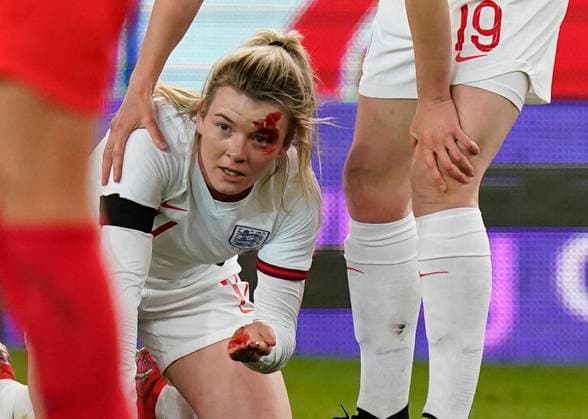 IMAGO Iconic Moments, Fußball - Frauen Bilder des Jahres 2021, Sport 04 April Sport Themen der Woche KW15 Sport Bilder des Tages Stoke, England, 13th April 2021. Lauren Hemp of England with a face injury during the International Football Friendly match at The Bet365 Stadium, Stoke. Picture credit should read: Andrew Yates Sportimage EDITORIAL USE ONLY. No use with unauthorised audio, video, data, fixture lists, club league logos or live services. Online in-match use limited to 120 images, no video emulation. No use in betting, games or single club league player publications. SPI-0999-0030