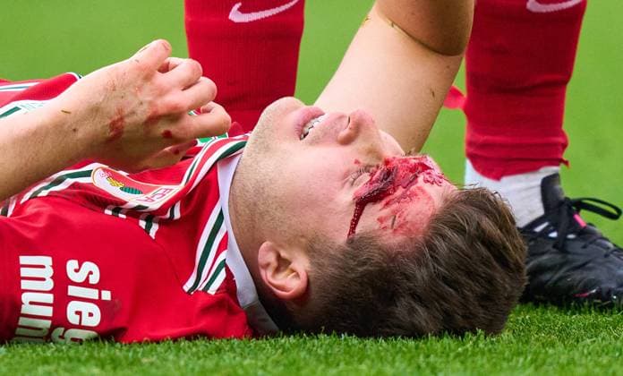Sport Themen der Woche KW11 Sport Bilder des Tages Elvis Rexhbecaj, FCA 13 head injury in the match FC AUGSBURG - FC SCHALKE 04 1.German Football League on Mar 18, 2023 in Augsburg, Germany. Season 2022 2023, matchday 24, 1.Bundesliga, 24.Spieltag