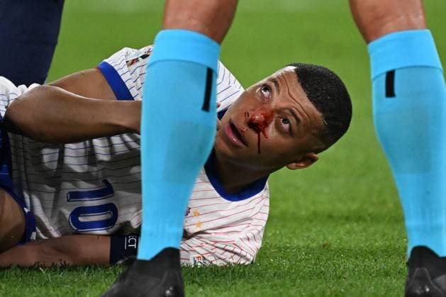 Bilder des Jahres 2024, Sport 06 Juni Sport Themen der Woche KW25 Sport Bilder des Tages 17.06.2024, xjhx, Fussball EM 2024, Österreich - Frankreich emspor, v.l. Kylian Mbappe Lottin (Frankreich) mit Schmerzen, verletzt, Verletzung blutet Nase Nasenbluten (DFL DFB REGULATIONS PROHIBIT ANY USE OF PHOTOGRAPHS as IMAGE SEQUENCES and or QUASI-VIDEO) Düsseldorf *** 17 06 2024, xjhx, Football EM 2024, Austria France emspor, v l Kylian Mbappe Lottin France with pain, injured, injury bleeding nose nosebleed DFL DFB REGULATIONS PROHIBIT ANY USE OF PHOTOGRAPHS as IMAGE SEQUENCES and or QUASI VIDEO Düsseldorf
