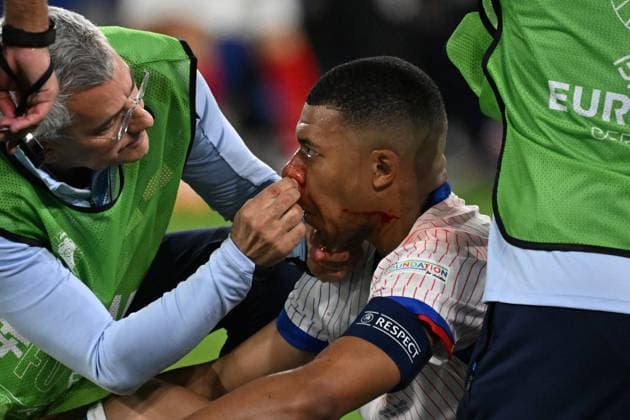 17 06 2024, xjhx, Football EM 2024, Austria France emspor, v l Kylian Mbappe Lottin France with pain, injured, injury bleeding nose nosebleed DFL DFB REGULATIONS PROHIBIT ANY USE OF PHOTOGRAPHS as IMAGE SEQUENCES and or QUASI VIDEO Düsseldorf