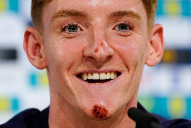 Anthony Gordon of England press conference, PK, Pressekonferenz showing his grazes and bruises from falling off electric bike England Press Conference, UEFA European Championship, EM, Europameisterschaft 2024, Round of 16, Football, Spa & Golf Resort Weimarer Land, Blankenhain, Germany, 28 Jun 2024 EDITORIAL USE ONLY No use with unauthorised audio, video, data, fixture lists, club league logos or live services. Online in-match use limited to 120 images, no video emulation. No use in betting, games or single club league player publications. Copyright: xDavexShopland Shutterstockx 14560774ak