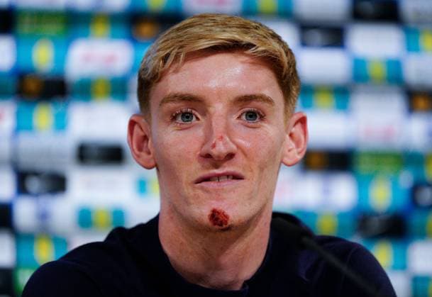 Anthony Gordon of England press conference, PK, Pressekonferenz showing his grazes and bruises from falling off electric bike England Press Conference, UEFA European Championship, EM, Europameisterschaft 2024, Round of 16, Football, Spa & Golf Resort Weimarer Land, Blankenhain, Germany, 28 Jun 2024 EDITORIAL USE ONLY No use with unauthorised audio, video, data, fixture lists, club league logos or live services. Online in-match use limited to 120 images, no video emulation. No use in betting, games or single club league player publications. Copyright: xDavexShopland Shutterstockx 14560774ai