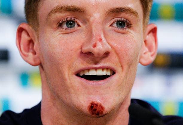Anthony Gordon of England press conference, PK, Pressekonferenz showing his grazes and bruises from falling off electric bike England Press Conference, UEFA European Championship, EM, Europameisterschaft 2024, Round of 16, Football, Spa & Golf Resort Weimarer Land, Blankenhain, Germany, 28 Jun 2024 EDITORIAL USE ONLY No use with unauthorised audio, video, data, fixture lists, club league logos or live services. Online in-match use limited to 120 images, no video emulation. No use in betting, games or single club league player publications. Copyright: xDavexShopland Shutterstockx 14560774al