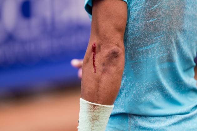 240718 A wound on Rafael Nadal arm during day 4 of the Nordea Open on July 18, 2024 in Bastad Photo Niclas Jönsson BILDBYRAN COP 273 NO0288 tennis atp 250 nordea open bbeng  Copyright: NICLASxJÖNSSON BB240718NO073