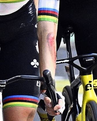 The injured arm of Slovenian Tadej Pogacar of UAE Team Emirates pictured at the finish of stage 11 of the 2025 Tour de France cycling, from and to Toulouse (154km), on Wednesday 16 July 2025 in France. The 112th edition of the Tour de France starts on Saturday 5 July in Lille, France, and will finish in Paris, France on the 27th of July. JASPERxJACOBS  x129381120x