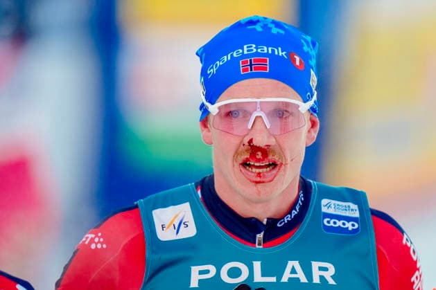 World Cup opening in team race, jumping and combined in Ruka. Ruka, Finland 20251130. Jan Thomas Jenssen with a bloody nose after the men s 20 km freestyle in Ruka on Sunday. Photo: Terje Pedersen NTB Ruka Finland EDITORIAL USE ONLY. RESTRICTED USE FOR BETTING COMPANIES Ref:_SPOO3FCB6h-uWY.jpg *** World Cup opening in team race, jumping and combined in Ruka Ruka, Finland 20251130 Jan Thomas Jenssen with a bloody nose after the men s 20 km freestyle in Ruka on Sunday Photo Terje Pedersen NTB Ruka Finland EDITORIAL USE ONLY RESTRICTED USE FOR BETTING COMPANIES  Copyright: xTerjexPedersenx xNTBx