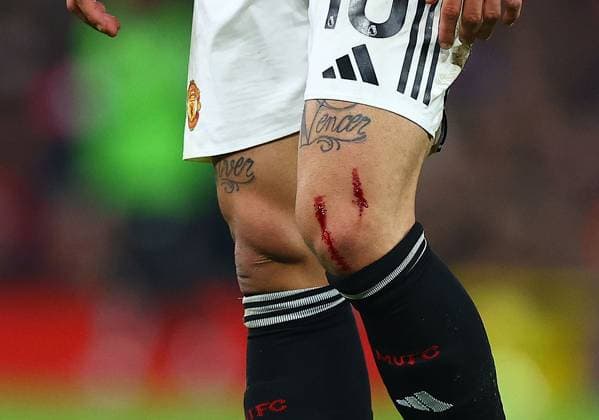 Sport Bilder des Tages A cut on the leg of Matheus Cunha of Manchester United, ManU Manchester United v West Ham United, Premier League, Football, Old Trafford, Manchester, UK - 04 Dec 2025Manchester Old Trafford United Kingdom EDITORIAL USE ONLY No use with unauthorised audio, video, data, fixture lists, club league logos or live services. Online in-match use limited to 120 images, no video emulation. No use in betting, games or single club league player publications. Copyright: xMattxWest Shutterstockx 16006102o