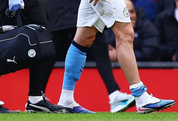 Erling Haaland of Manchester City sports a cut a scratches on their leg Manchester United, ManU v Manchester City, Premier League, Football, Old Trafford, Manchester, UK - 17 Jan 2026Manchester Old Trafford United Kingdom EDITORIAL USE ONLY No use with unauthorised audio, video, data, fixture lists, club league logos or live services. Online in-match use limited to 120 images, no video emulation. No use in betting, games or single club league player publications.  Copyright: xMattxWest Shutterstockx 16347907v