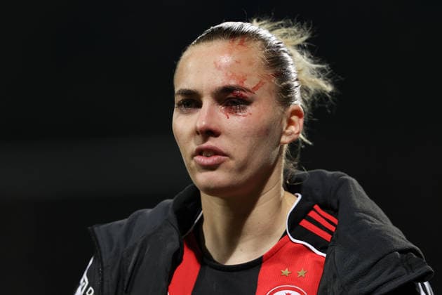 FBL Womens Bundesliga Eintracht Frankfurt and TSG Hoffenheim Laura Freigang Eintracht Frankfurt is injured in the eye during the Google Pixel Womens Bundesliga match between Eintracht Frankfurt and TSG Hoffenheim on March 18, 2026, at Stadion am Brentanobad in Frankfurt am Main, Germany Copyright: JoaquimxFerreira