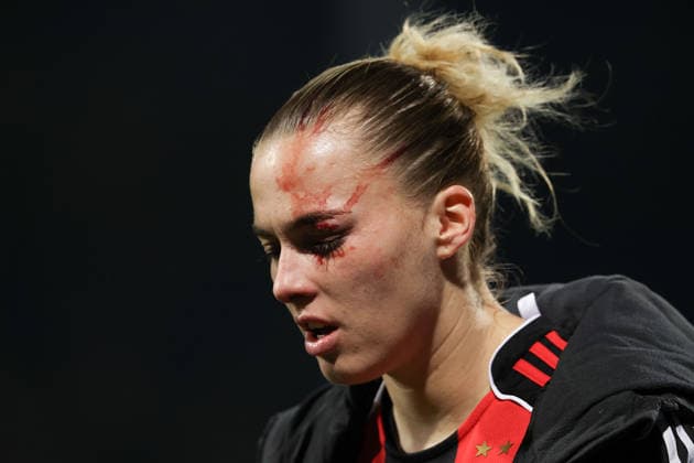 FBL Womens Bundesliga Eintracht Frankfurt and TSG Hoffenheim Laura Freigang Eintracht Frankfurt is injured in the eye during the Google Pixel Womens Bundesliga match between Eintracht Frankfurt and TSG Hoffenheim on March 18, 2026, at Stadion am Brentanobad in Frankfurt am Main, Germany Copyright: JoaquimxFerreira