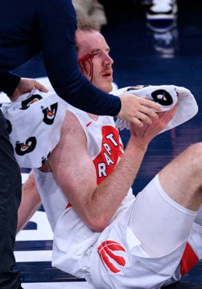 March 25, 2026, Inglewood, California, USA: JAKOB POELTL (19) of the Toronto Raptors bleeds after being stroke to the side of the right eye during a regular season NBA, Basketball Herren, USA game against the Los Angeles Clippers on Wednesday at Intuit Dome Arena in Inglewood. NBA 2026: Clippers vs Raptors  - ZUMAp124 20260325_zaa_p124_007 Copyright: xJavierxRojasx