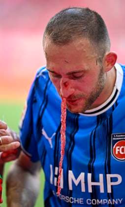Sport Bilder des Tages 02.05.2026, Fussball Bundesliga 2025 2026, 32.Spieltag, FC Bayern München - 1.FC Heidenheim, in der Allianz-Arena München, Jonas Föhrenbach (1. FC Heidenheim 1846) blutet heftig ***DFL and DFB regulations prohibit any use of photographs as image sequences and or quasi-video.*** *** 02 05 2026, Fußball Bundesliga 2025 2026, 32 Spieltag, FC Bayern München 1 FC Heidenheim, in der Allianz Arena München, Jonas Föhrenbach 1 FC Heidenheim 1846 bleeds violently DFL and DFB regulations prohibit any use of photographs as image sequences and or quasi video