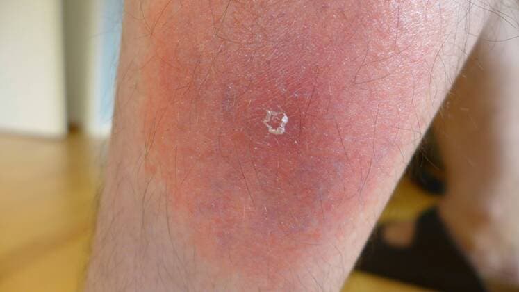 gefaehrliche Roetung einer Borrelioseinfektion an einem Bein nach Zeckenbiss, Deutschland dangerous flush of an infection of borreliosis at a leg after tick bite, Germany BLWS347230