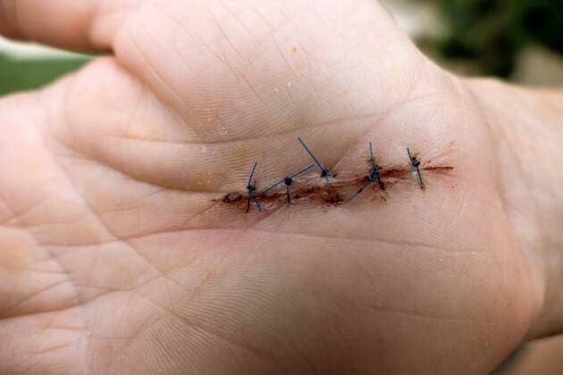 Naht an einer Hand nach einem Karpaltunnelsyndrom McPWOD McPWOD
