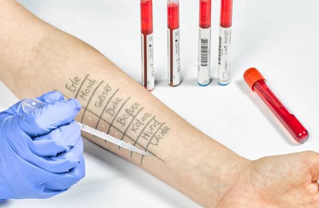 Allergie und Allergietest Der Pricktest dient zum Nachweis einer sogenannten Typ I Allergie, wie zum Beispiel einer Sensibilisierung gegenüber Pollen oder Tierhaaren. Hierbei wird ein definierter Allergenextrakt auf die Haut aufgetropft und diese anschließend mit einer Lanzette leicht angestochen, sodass die jeweilige Substanz in die Oberhaut eindringen kann. Die Testreaktion kann nach 20 Minuten im Vergleich zu zwei immer mit durchgeführten Leertestungen ( Positivkontrolle mit Histamin und wirkstofffreier Negativkontrolle ) abgelesen werden. Beurteilt werden die Hautrötung und die Quaddelgröße. xAGJPGx