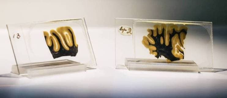 Entertainment Bilder des Tages Histologische Schnitte aus dem Gehirn von Albert Einstein, Leihgabe vom Muetter Museum Philadelphia (USA), in der Sonderausstellung Das Gehirn - Intelligenz, Bewusstsein, Gefuehl im LWL-Museum für Naturkunde, Muenster, 26.06.18. Das LWL-Naturkundemuseum in Muenster erkundet ab Freitag (29.06.18) in einer grossen Themenschau die anatomische Vielfalt und Leistungskraft des Gehirns. Auf einer Ausstellungsflaeche von 1.200 Quadratmetern werden 770 Objekte gezeigt. Unterteilt in 13 Themenbereiche sollen die Exponate Aufschluss geben ueber das komplexe Organ, das Handlungen bestimmt, die Persoenlichkeit formt und fuer die Gefuehle verantwortlich ist. Wertvollstes Exponat sind zwei Scheiben aus dem Gehirn von Albert Einstein (1879-1955). Der US-Pathologe Thomas Harvey hatte nach dem Tod des Nobelpreistraegers und Begruenders der Relativitaets Copyright: epd-bild FriedrichxStark EDITORIAL USE ONLY