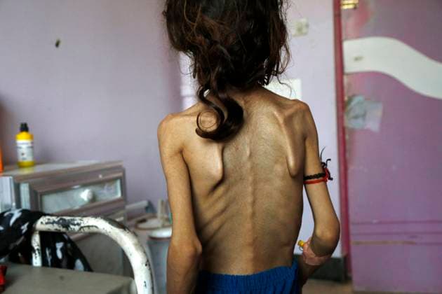 IMAGO Creative: Hunger Jemen, Hunger leidende Kinder in Sanaa (190914) -- SANAA, Sept. 14, 2019 -- Sadia Ibrahim stands inside her room where she receives medical treatment at an anti-malnutrition treating center in Al-Sabeen hospital in Sanaa, Yemen, on Sept. 12, 2019. Sadia Ibrahim facepalmed herself feeling dizzy after the doctor diagnosed her as skin and bones. The 11-year-old severely malnourished girl now weighs around 12 kg. She lies on a bed in Al-Sabeen hospital in Yemen s capital Sanaa to receive treatment as doctors and her poor parents are trying to rescue her life. TO GO WITH Feature: Hunger kills Yemen s children in silence, no one hears (Photo by Mohammed Mohammed Xinhua) YEMEN-SANAA-HUNGER-CHILDREN NiexYunpeng 
