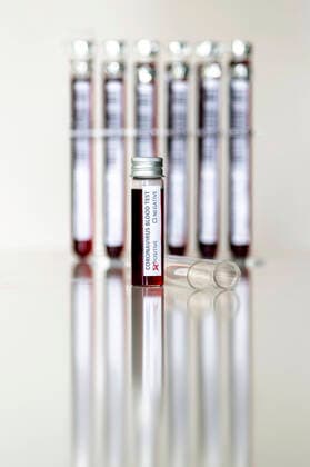 Blood sample in a test tube for coronavirus analysis and for the production of a vaccine Dummy Foto:xD.xAnoraganingrumx xFuturexImage