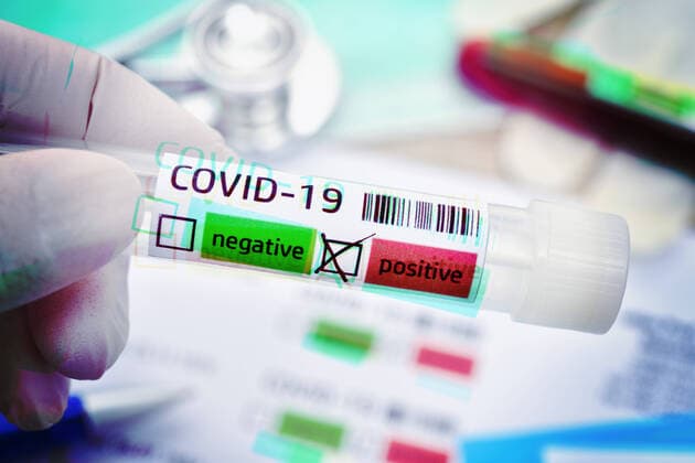 Swab tubes with positive Covid 19 result, symbol photo coronavirus ** NUR FUER REDAKTIONELLE ZWECKE ** EDITORIAL USE ONLY **