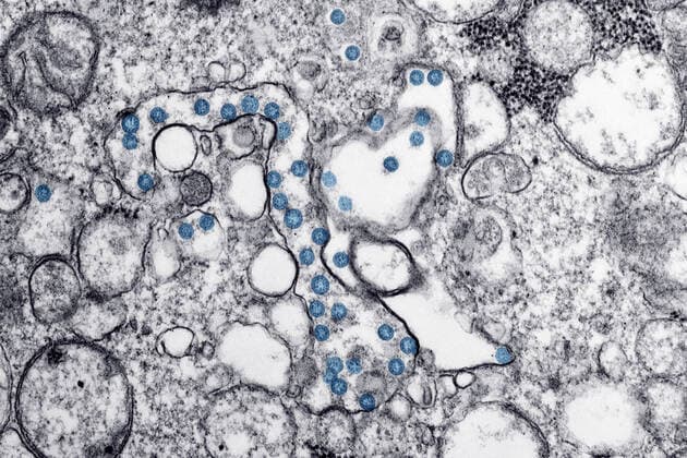 Transmission electron microscopic image of an isolate from the first U.S. case of COVID-19, formerly known as 2019-nCoV. The spherical viral particles, colorized blue, contain cross-sections through the viral genome, seen as black dots. CDC  WAX2020031504 CDC
