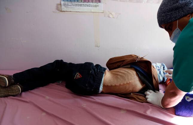 IMAGO Creative: Hunger (201229) -- SANAA, Dec. 29, 2020 -- Twelve-year-old Murad Mohammed, who suffers from acute malnutrition, is examined by a doctor at the malnutrition treating ward in Al-Sabeen hospital in Sanaa, Yemen, Dec. 27, 2020. (Photo by Xinhua) YEMEN-SANAA-MALNOURISHED CHILD MohammedxMohammed 