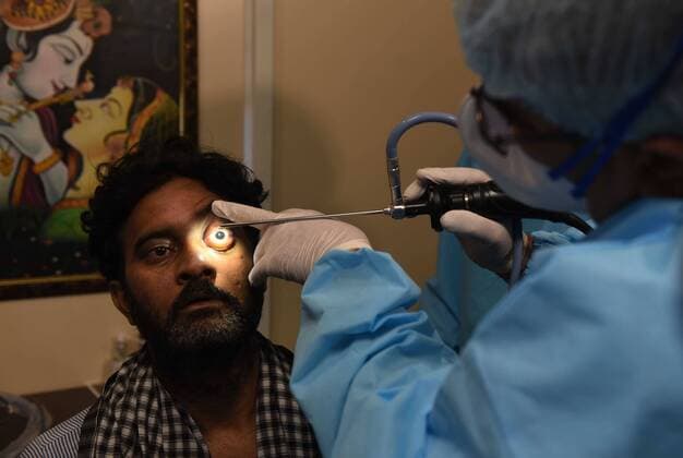 News Themen der Woche KW22 News Bilder des Tages Coronavirus in Indien, landesweite Eindrücke GHAZIABAD, INDIA - JUNE 3: ENT specialist Dr. Brajpal Singh Tyagi examines a patient who recovered from Covid-19 prior to a surgery to remove Mucormycosis (Black Fungus), at a hospital on June 3, 2021 in Ghaziabad, India. Black fungus, also known as Mucormycosis, is a rare but dangerous infection. Black fungus is caused by getting into contact with fungus spores in the environment. According to medical experts, the main cause of black fungus (mucormycosis) is steroid misuse during COVID treatment. (Photo by Ajay Aggarwal Hindustan Times) Treatment Of Mucormycosis Black Fungus Patients