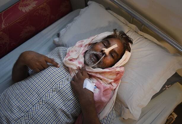 Coronavirus in Indien, landesweite Eindrücke GHAZIABAD, INDIA - JUNE 3: A Black Fungus patient recovering in a hospital after a surgery to remove black fungus (Mucormycosis) on June 3, 2021 in Ghaziabad, India. Black fungus, also known as Mucormycosis, is a rare but dangerous infection. Black fungus is caused by getting into contact with fungus spores in the environment. According to medical experts, the main cause of black fungus (mucormycosis) is steroid misuse during COVID treatment. (Photo by Ajay Aggarwal Hindustan Times) Treatment Of Mucormycosis Black Fungus Patients