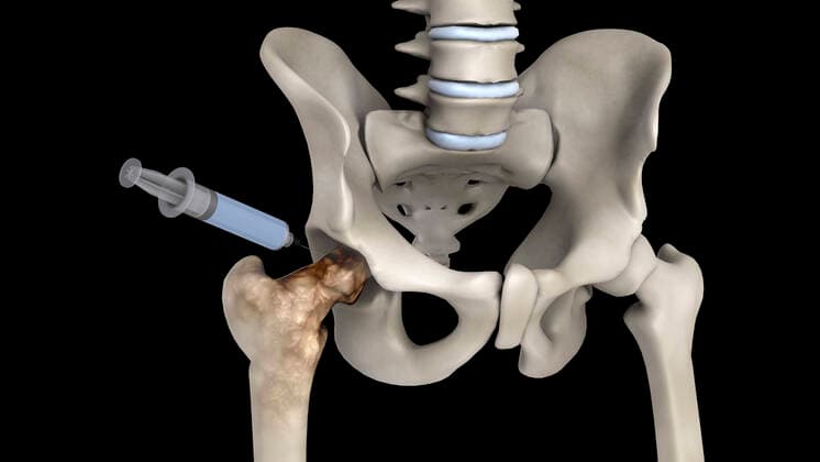 Biomedical illustration showing the treatment of osteoporosis. Copyright: StocktrekxImages STK701549H