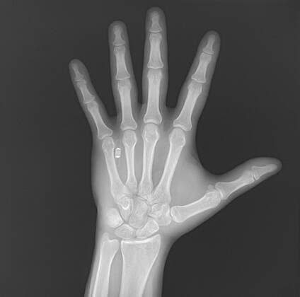 EXCLUSIVE VIDEO AVAILABLE: CONTACT INFO@COVERMG.COM The future of wireless payments is here - as tech enthusiasts can now get a chip implanted under their skin that means they can order drinks or complete the weekly shop with just a swipe of their hand. British-Polish firm Walletmor offers to implant the chips beneath the skin in customers? hands for as little as â?¬199. It weighs less than a gram, is little bigger than a grain of rice - and is comprised of a tiny secure microchip and an antenna encased in a biopolymer. Founder and chief executive Wojtek Paprota says: We are the first and only company on Earth that has designed payment implants that are fully biosafe, fully secure, and globally available. The difference between Copyright: xx 51454118 EDITORIAL USE ONLY. NOT FOR USE BY NEWSPAPERS BASED IN THE UK.