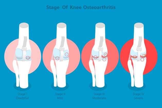 3D Isometric Flat Conceptual Illustration of Stage Of Knee Osteoarthritis, Anatomy of Leg Joints<br>3D Isometric Flat Conceptual Illustration of Stage Of Knee Osteoarthritis, Anatomy of Leg Joints 3D Isometric Flat Conceptual Illustration of Stage Of Knee Osteoarthritis, Anatomy of Leg Joints 3D Isometric Flat Conceptual Illustration of Stage Of Knee Osteoarthritis, Anatomy of Leg Joints Copyright: xZoonar.com AnastasiiaxTorianykx 22978844