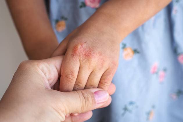 Nahaufnahme einer Erwachsenenhand, die die Hand eines Kindes mit sichtbaren Anzeichen von Neurodermitis, trockener und gereizter Haut, hält, als Symbol für medizinische Versorgung, familiäre Unterstützung, Zärtlichkeit und Dermatologiekonzept Nahaufnahme einer Erwachsenenhand, die die Hand eines Kindes mit sichtbaren Anzeichen von Neurodermitis, trockener und gereizter Haut, hält, als Symbol für medizinische Versorgung, familiäre Unterstützung, Zärtlichkeit und Dermatologiekonzept (License=RF) ,model released, Symbolfoto Copyright: xZoonar.com EvgeniiaxGordeevax 24251026 ,model released, Symbolfoto ,property released