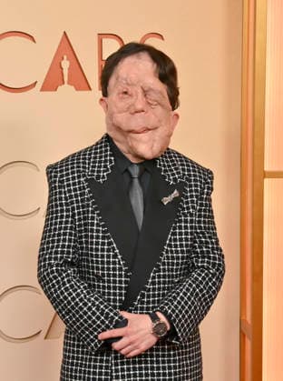 Adam Pearson arrives on the red carpet for the 98th annual Academy Awards in the Hollywood section of Los Angeles on Sunday, March 15, 2026. Conan O Brien will host the Oscars for the second consecutive year.  LAP20260315167 JIMxRUYMEN