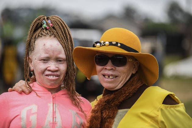 International Albinism Awareness Day in Kenya THIKA, KENYA - JUNE 13: People with albinism take part in activities marking International Albinism Awareness Day, advocating for equal participation in society and raising awareness about the challenges they face across Africa, including discrimination, exclusion and violent attacks, on June 13, 2026, in Thika, Kenya. The annual observance, led by the United Nations, aims to combat prejudice surrounding albinism, protect fundamental human rights and highlight global efforts to end violence against people with albinism. Gerald Anderson Anadolu Thika Kenya. Editorial use only. Please get in touch for any other usage.  Copyright: x2026xAnadoluxGeraldxAndersonx