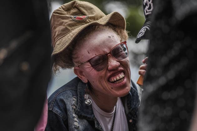 International Albinism Awareness Day in Kenya THIKA, KENYA - JUNE 13: People with albinism take part in activities marking International Albinism Awareness Day, advocating for equal participation in society and raising awareness about the challenges they face across Africa, including discrimination, exclusion and violent attacks, on June 13, 2026, in Thika, Kenya. The annual observance, led by the United Nations, aims to combat prejudice surrounding albinism, protect fundamental human rights and highlight global efforts to end violence against people with albinism. Gerald Anderson Anadolu Thika Kenya. Editorial use only. Please get in touch for any other usage.  Copyright: x2026xAnadoluxGeraldxAndersonx