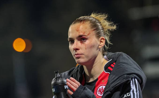 GER, Frankfurt, Eintracht Frankfurt vs TSG Hoffenheim, Google Pixel Bundesliga, Football, DFB, Season 2025 2026, Stadion am Brentanobad, 15 Matchday in picture Injury to Laura Freigang Eintracht Frankfurt Women 10 , blood, eye, injured, substitution DFB DFL REGULATIONS PROHIBIT ANY USE OF PHOTOGRAPHS AS IMAGE SEQUENCES AND OR QUASI VIDEO, 18 03 2026 Copyright: HMBxMedia HendrikxHamelau