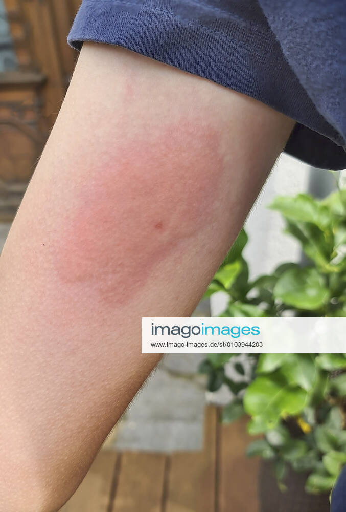 Wasp sting at the arm of a child, Germany wasp sting at an arm of a child, Germany BLWS628114