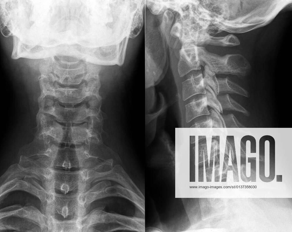 X ray,neck vertebrae,radiology,x-rays,xray,xrays 1un-gk8