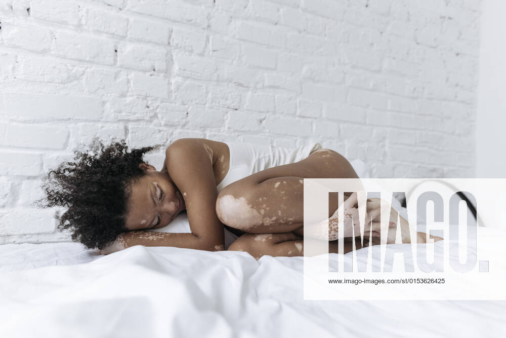 Woman with vitiligo resting on bed at home model released, SIF00005