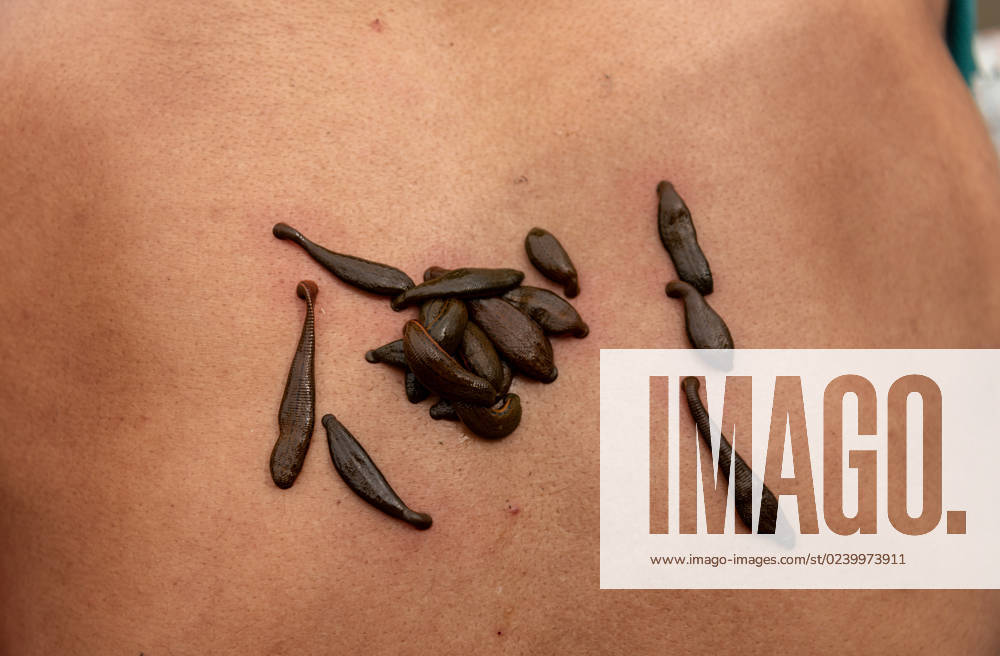 A Kashmiri man receives leech treatment on his back on the bank of Dal Lake. Every year on Nowroz 21st March, traditional health workers in Kashmir use leeches to treat people who have itchy, painful lumps on their skin called chilblains that develop during the winter. Thousands of patients with various skin problems receive leech treatment at Hazratbal in Srinagar. Srinagar India - ZUMAs197 20230321_zaa_s197_008
