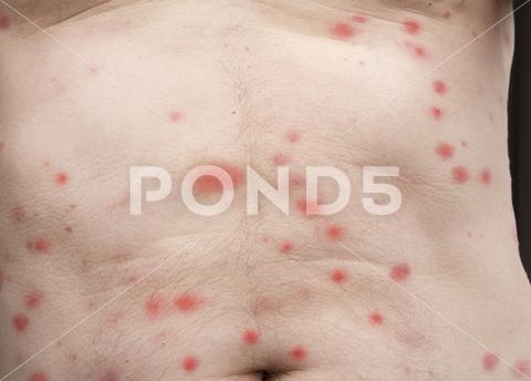 Bites of insect on male body. Bed bugs or flea. skin, disease, dermatology, infect, pimple, painful, body, irritated, bite, scab, allergic, dermatitis, reaction, insect, sting, detail, spot, texture, closeup, parasite, pain, dermatological, healthcare, pink, flesh, red, textured, human, medicine, infectious, epidermis, macro, allergy, mosquito, infection, illness, wound, toxic, medical, flea, insect, bed, bug, spider, male, body,