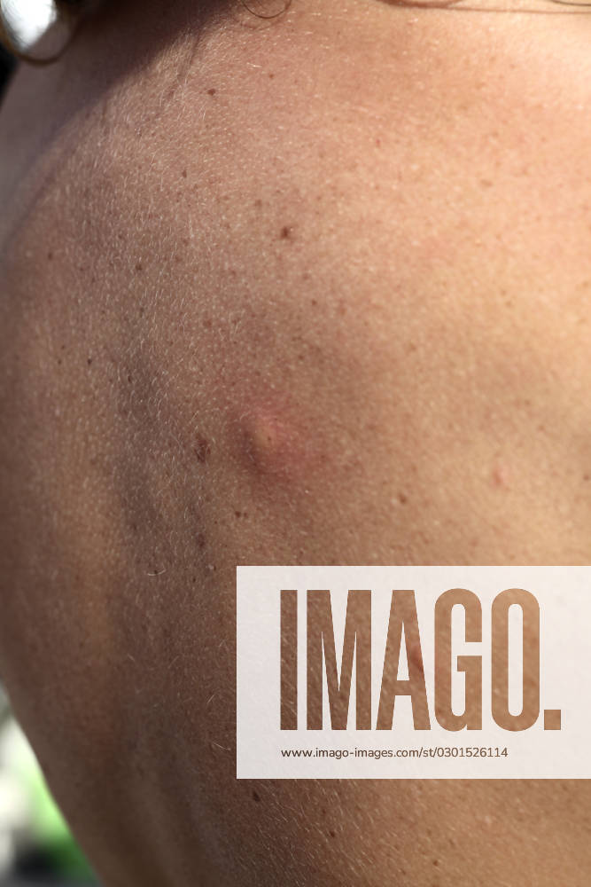 Insect bite Mosquito bite with allergy.