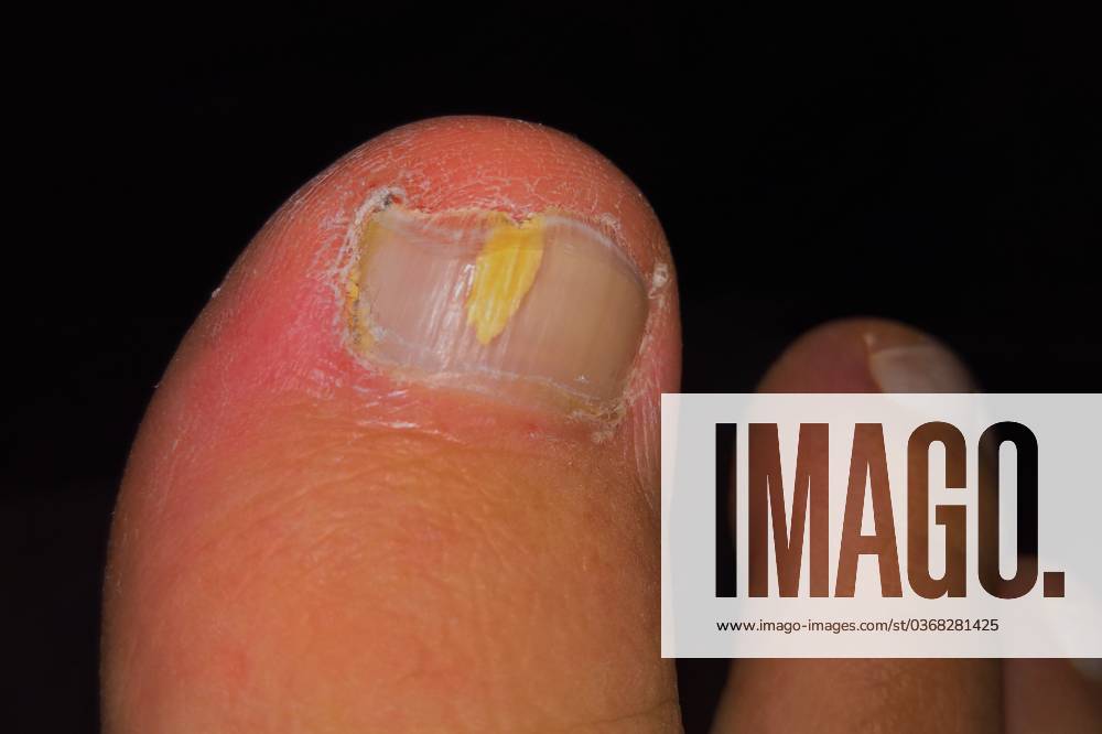 Nail fungus, also known as nail mycosis or onychomycosis, is an infection of the toes or fingernails caused by dermatophytes, i.e. filamentous fungi, yeast fungi or molds Internal endogenous disposition factors can be, for example, metabolic diseases Doctor, family doctor, dermatologist, suspected diagnosis Nail fungus Dermatophytes