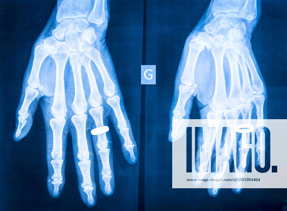 X-ray of rheumatism in the hands. Rheumatism 013843_010
